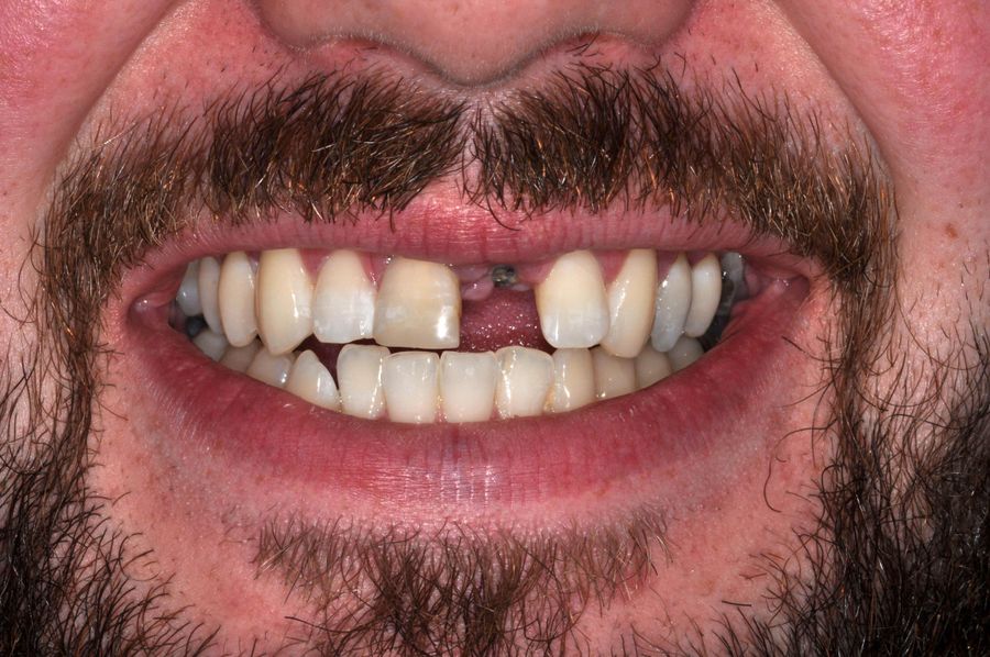 What Material Are Dental Implants Made Of - single tooth implant - before - 3Dental